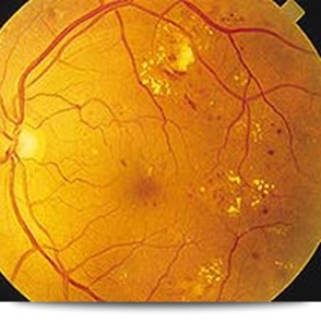 retinopatia diabetica-oftalmologia de la calzada-clinica en albacete