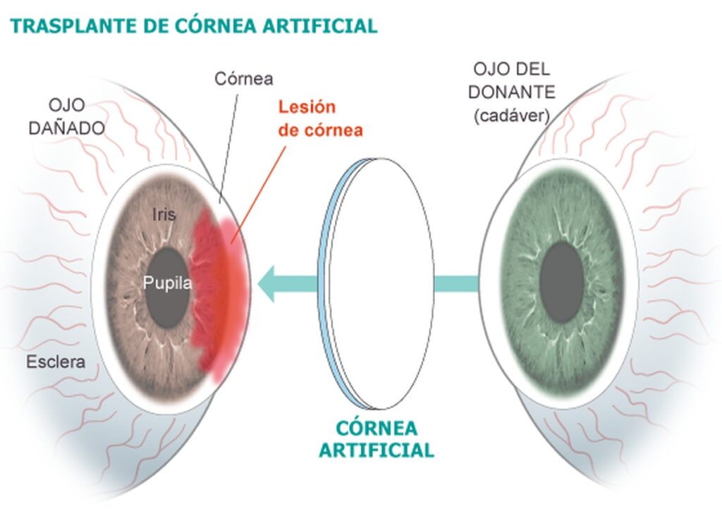 transplante de cornea