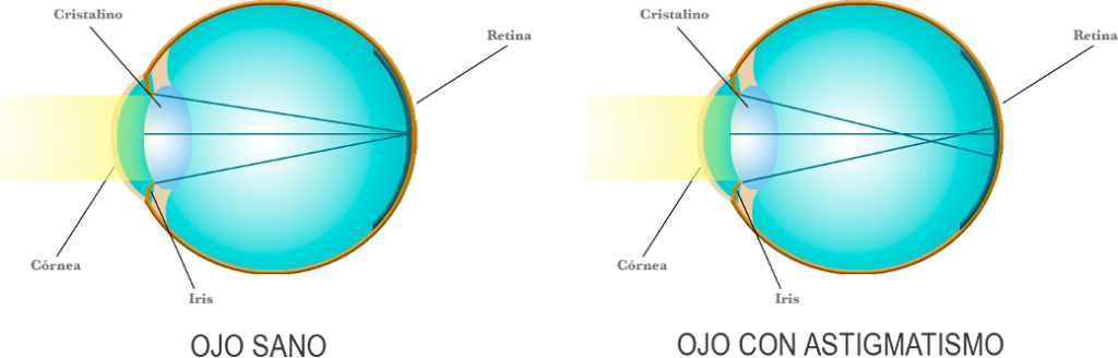 astigmatismo-cirugia refractiva-laseer n los ojos-clinica oftalmológica de la Calzada-